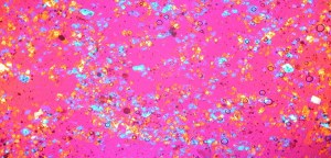 Same-Day Surgery OK for OA Knees | Orthopedics This Week