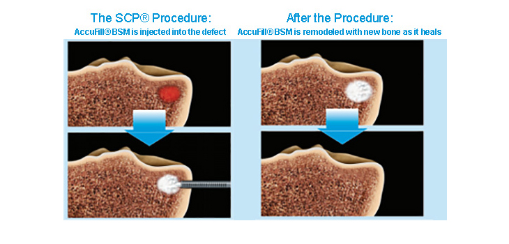 Subchondroplasty Viable Option for Hip Joint Replacement | Orthopedics