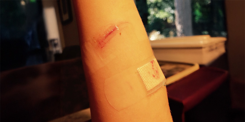 Cracking the Code on the Elusive Dubberley IIA Elbow Fracture