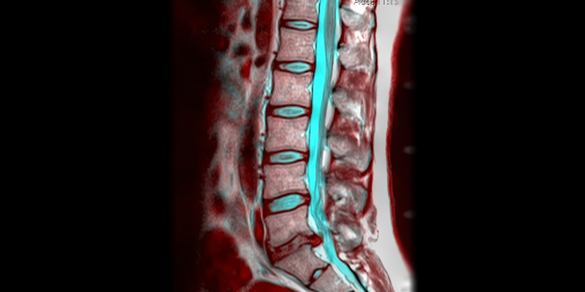 New Algorithm Brings Order to Discogenic Pain Chaos