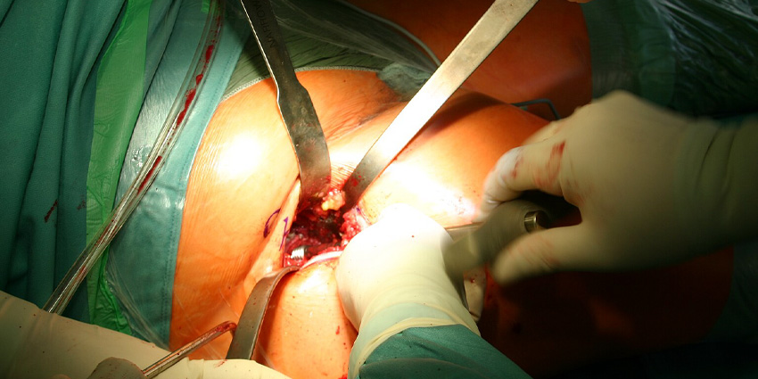 The Glutes Don’t Lie, Open or Endoscopic!