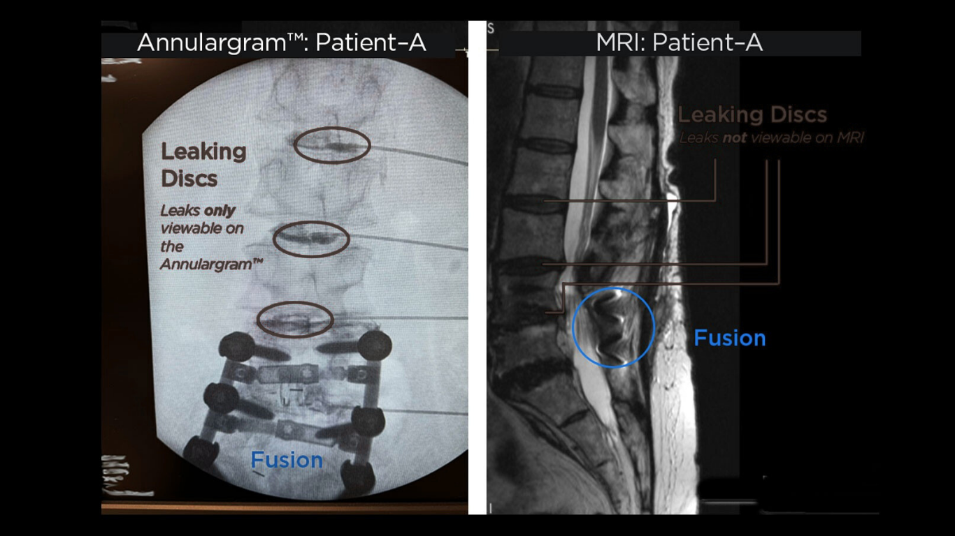 A New Tool in the Non-Surgical Spine Toolbox: DISCSEEL® Comes to NYC
