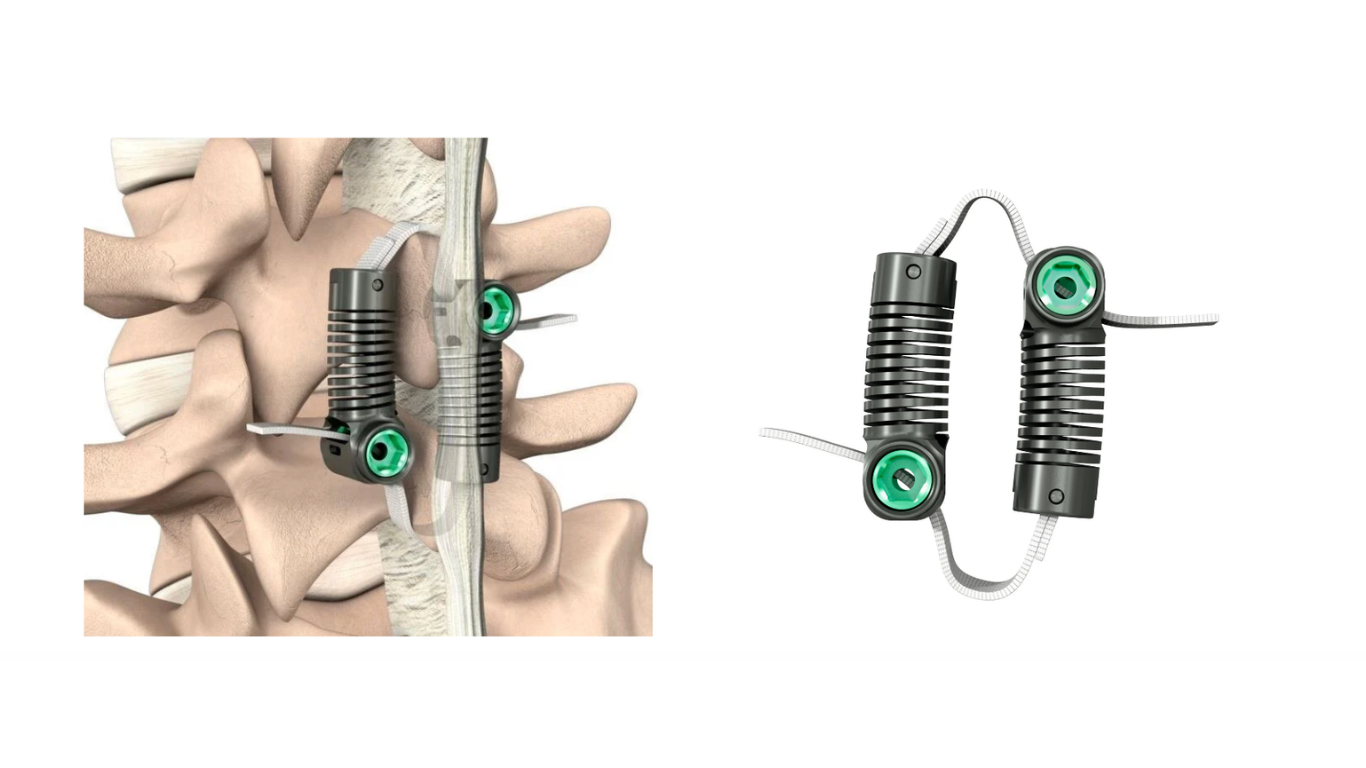FDA Approves (PMA) Dynamic Sagittal Tethering for Spondy