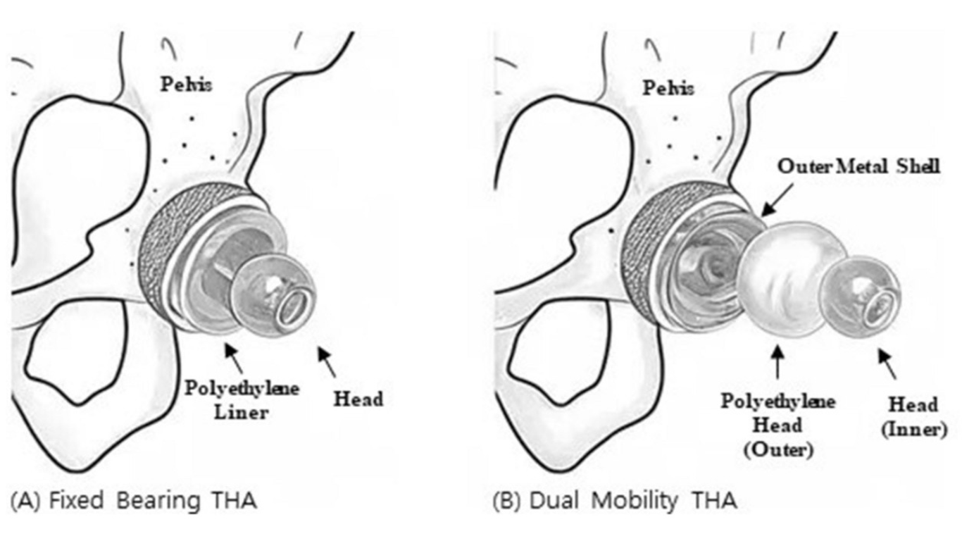 Dual Mobility vs. Jumbo Heads in Primary THA