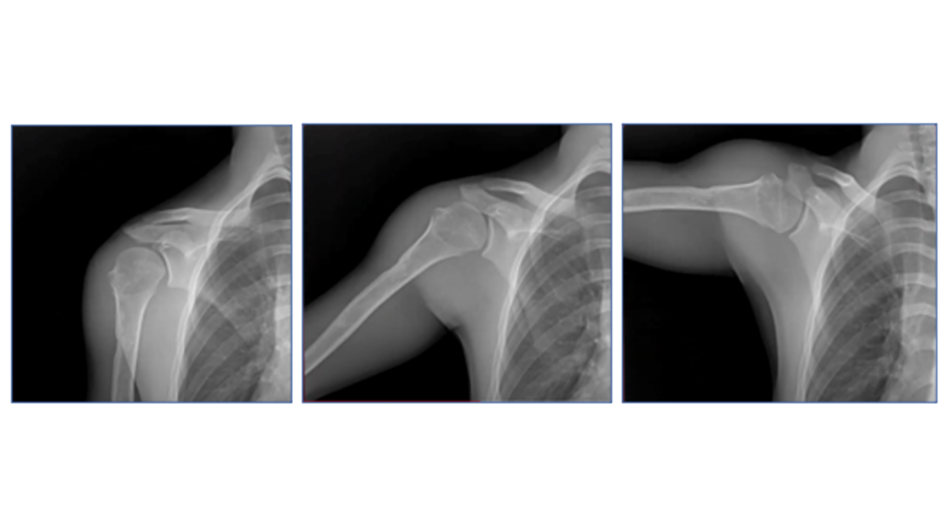 Emory Researchers Demonstrate the Power of Dynamic Digital Radiography to Quantify Functional Outcomes After Total Shoulder Arthroplasty