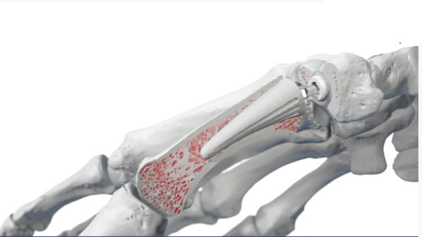 The Thumb That Changed the Game: FL Surgeons Debut New CMC Joint