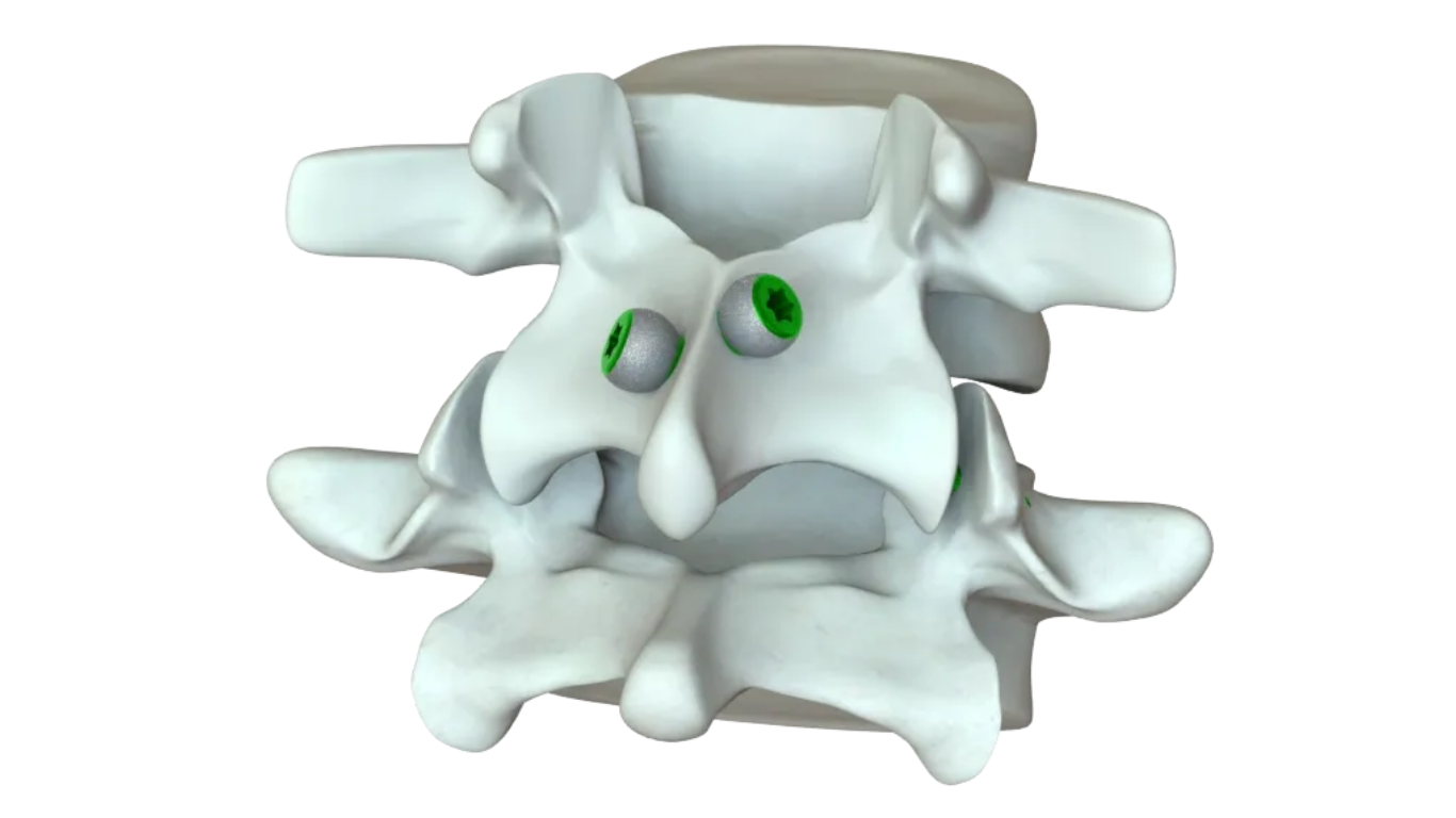 Vy Spine Announces FDA Clearance for DiversiVy™ Facet Screw