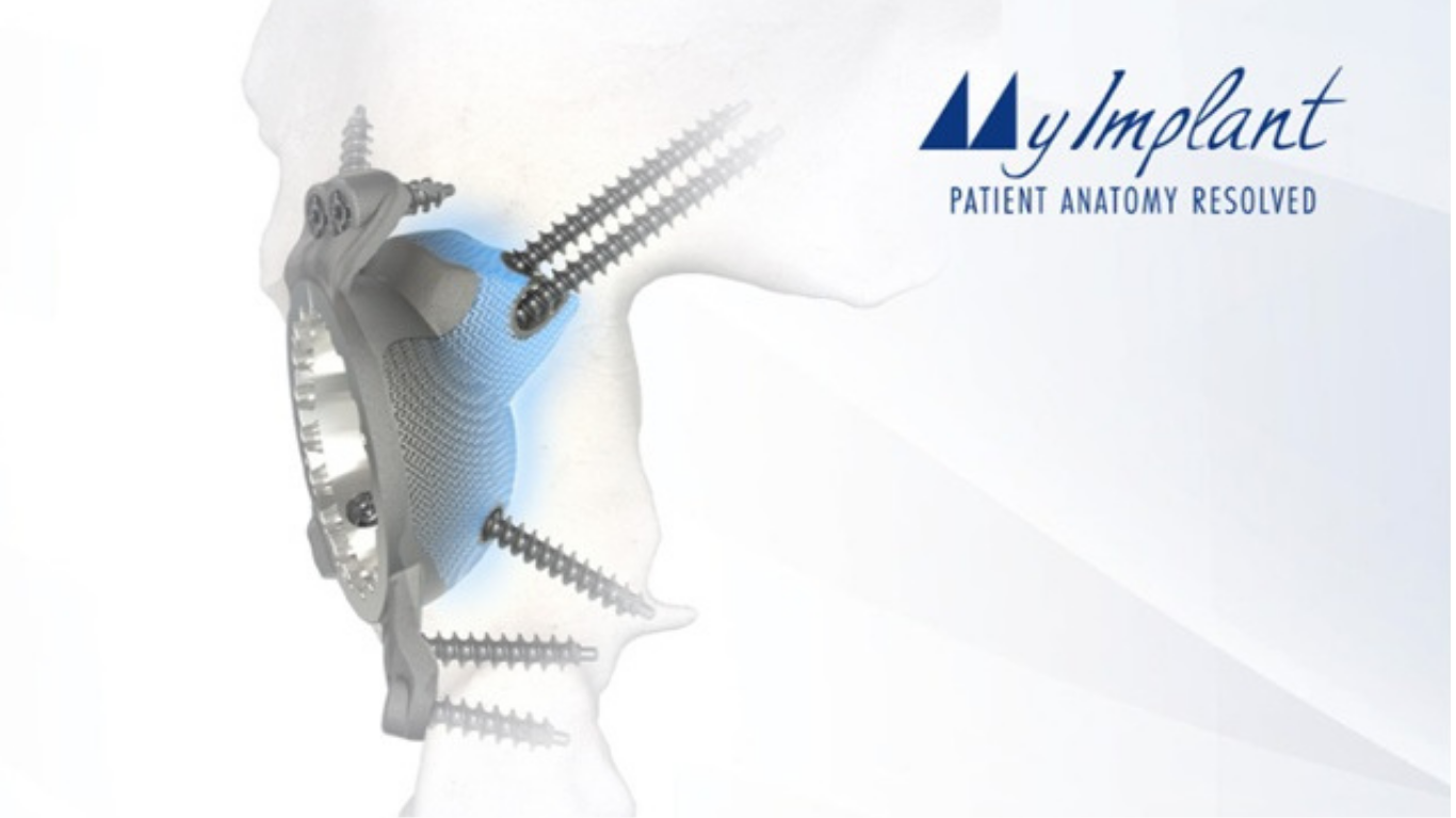 Medacta Extends MyImplant Platform to&nbsp;Complex Hip Reconstruction